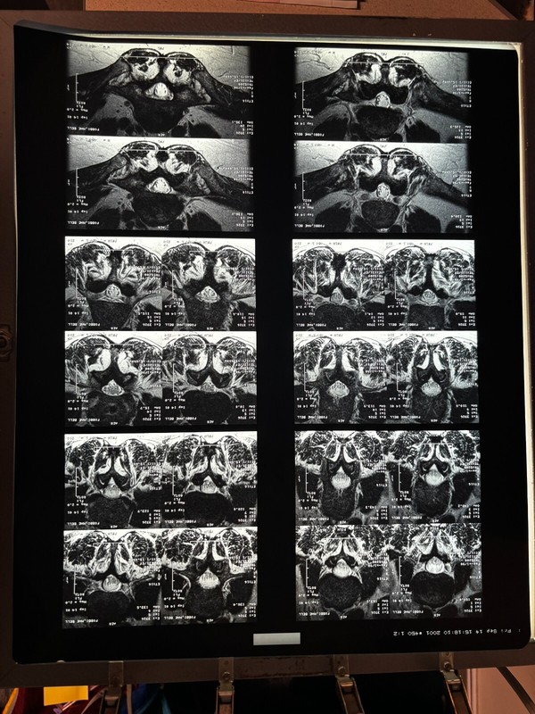 Lot of 2 large 14x17" MRI Lumbar Spine on X-ray Film silver content art oddity gallery