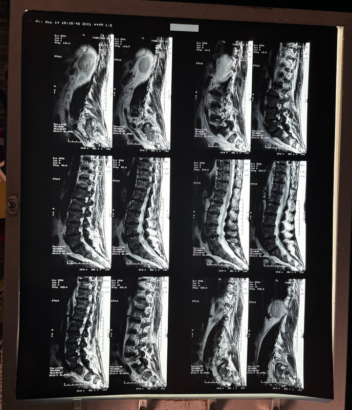 Lot of 2 large 14×17″ MRI Lumbar Spine on X-ray Film silver content art oddity